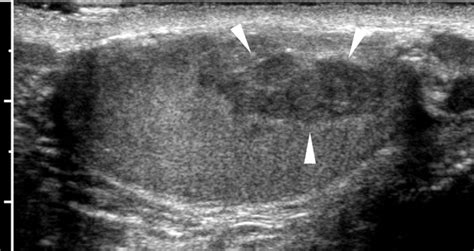 Adrenal Rests Longitudinal Sonogram In An 18 Year Old With Known