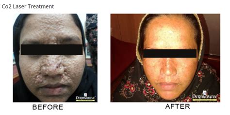 laser treatment laser treatment center  india