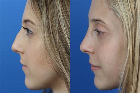 Best Nose Job Noses Images Nose Job Nose Rhinoplasty Hot Sex Picture