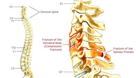 Cervical Fracture