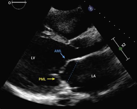 Basic Principles Of The Echocardiographic Evaluation Of Mitral