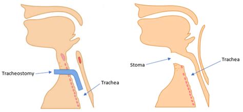 Tracheostomy Emergencies In Adults RCEMLearning