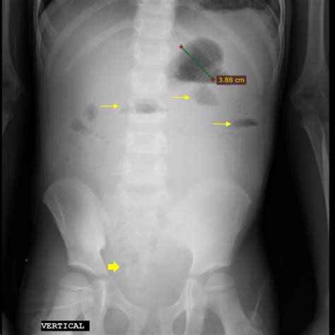 Target Sign Intussusception X Ray - Many plain radiographic signs of ...