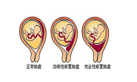 前置胎盘 概述 健康典吧