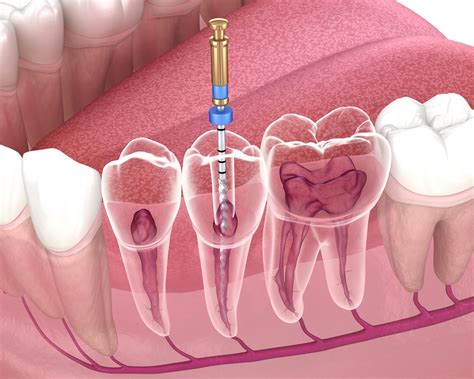 Endodoncia Qué Es Y Cómo Se Realiza Cooldent Algeciras