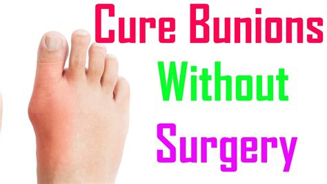 Ways Treat Bunions Without Surgery How To Treat Bunions Without