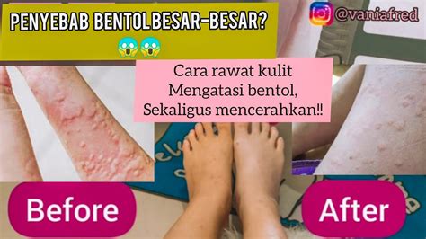 Cara Mengatasi Bentol Bentol Besar Kemerahan Penyebabnya Dan Cara