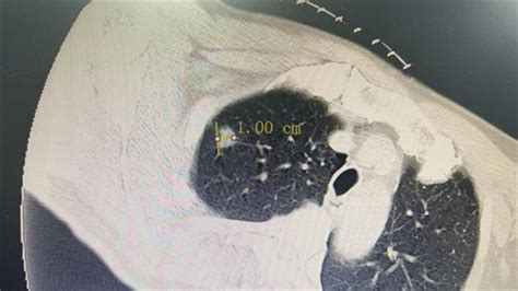 市二医院呼吸与危重症医学科成功开展肺部肿瘤射频消融术 景德镇市第二人民医院