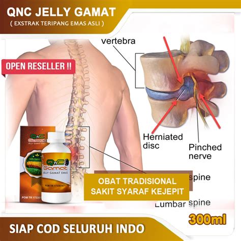 Jual Obat Saraf Kejepit Di Pinggang Cedera Pada Tulang Belakang Alami