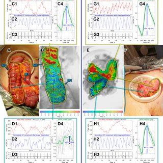 Intestinal Blood Perfusion In The Case Of Side To Side Anastomosis