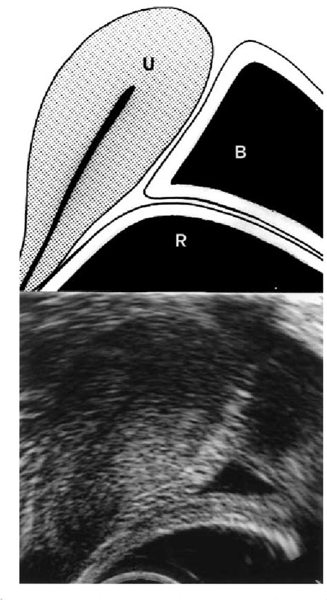 Figure From Transrectal Ultrasonography In The Assessment Of