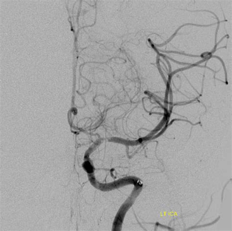 Intracranial Arterial Dissection Neuroangio Org