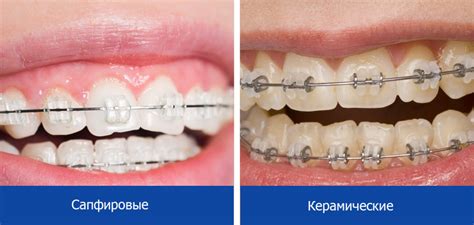 Керамические брекеты, цена установки (лигатурные и безлигатурные ...