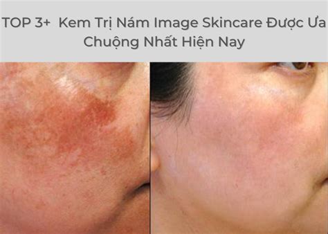 TOP 3 Serum Trị Nám Image Skincare Được Ưa Chuộng Nhất Hiện Nay