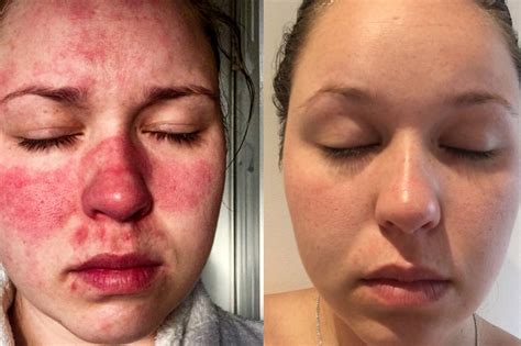 Rosacea Symptoms Woman With Skin Condition That Made It ‘agony To