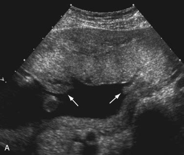 Placenta Circumvallata | Radiology Key