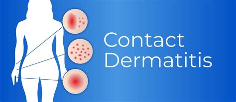 Contact Dermatitis Background Illustration 41507745 Vector Art At Vecteezy