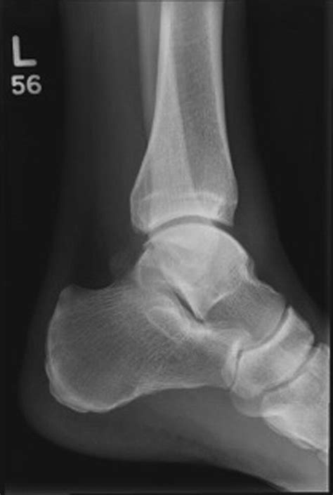 Posterior Ankle Impingement In Dancers And Athletes Foot And Ankle