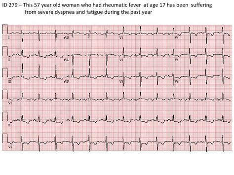 Stepwise Interpretation Of Ecg Id279