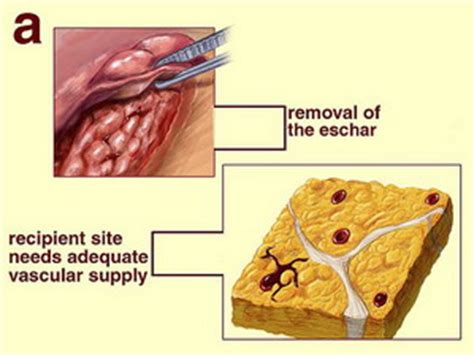 Skin Beauty - Skin Grafting Technique