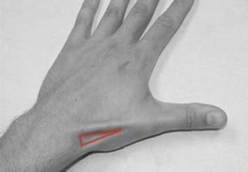 lunate dislocation brown emergency medicine blog