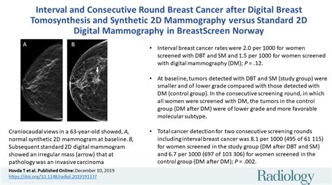 Interval And Consecutive Round Breast Cancer After Digital Breast