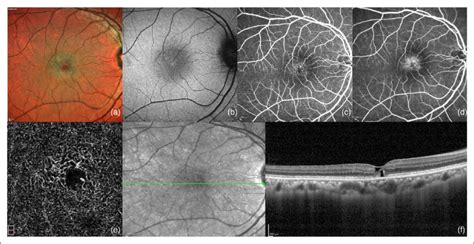 Group C Type 2 Macular Telangiectasia With History Of Tamoxifen Use A