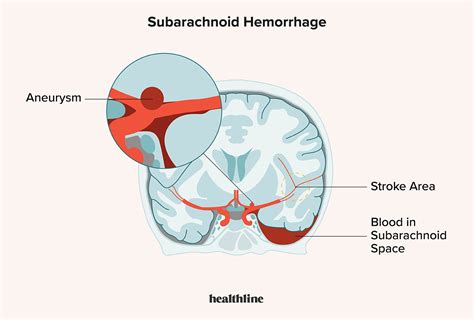 Subarachnoid Space