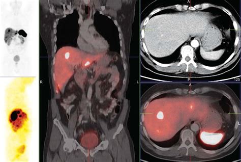 A To E Ga Dotatate Pet Ct Maximum Intensity Projection A And B