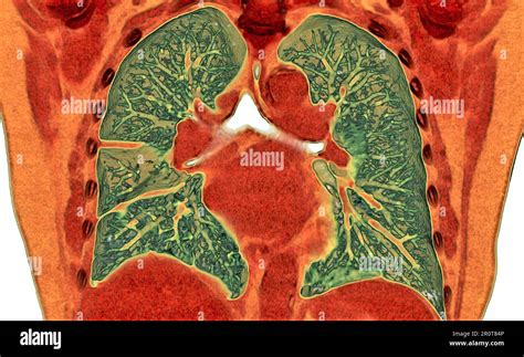 Pleural Effusion Ct Scan Stock Photo Alamy