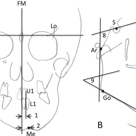 Cephalometric Measurements A Anteroposterior Cephalometric Download Scientific Diagram