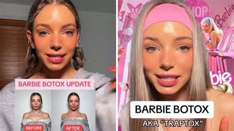 Barbie Botox Viral Cosmetic Neck Surgery On Tiktok Oicanadian