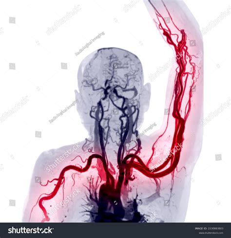Brachial Arteries Arm Upper Extremity Bone Stock Illustration