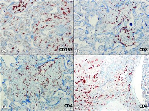 Immunohistochemical Findings A Cd163 Positive Macrophages In The Download Scientific Diagram