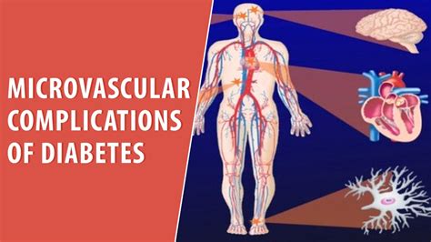 Microvascular Complications Of Diabetes Cardiovisual Trusted