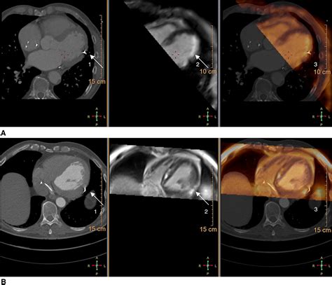 Medtronic Ct Sinus Protocol Captions Beautiful