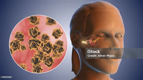 Ear Wax Bacterial Infection Medical Concept Stock Photo - Download ...