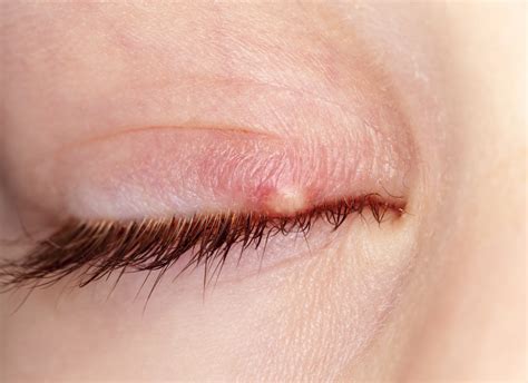 How Can You Tell The Difference Between A Stye And Blepharitis Balmonds