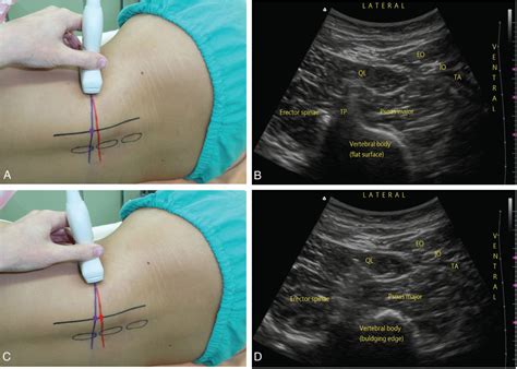 Finding The Bulging Edge A Modified Shamrock Lumbar Plexus Block In