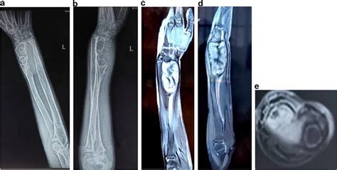 A Anteroposterior AP And B Lateral Radiographs Reveal Extensive