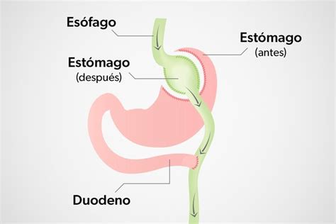 Cirugía bariátrica qué es tipos y riesgos Tua Saúde