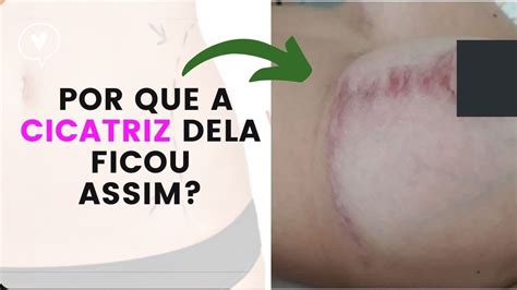 Antes E Depois Da Cirurgia Plastica Por Que A Cicatriz Dela Ficou