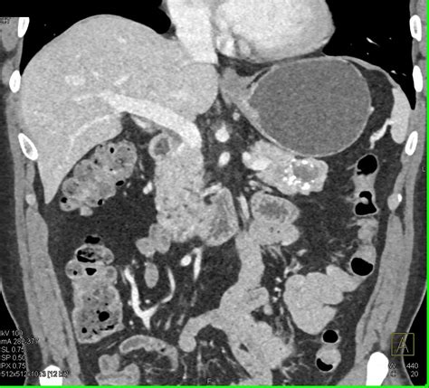 Neuroendocrine Tumor Tail Of The Pancreas With Liver Metastases