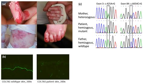 Dominant Dystrophic Epidermolysis Bullosa