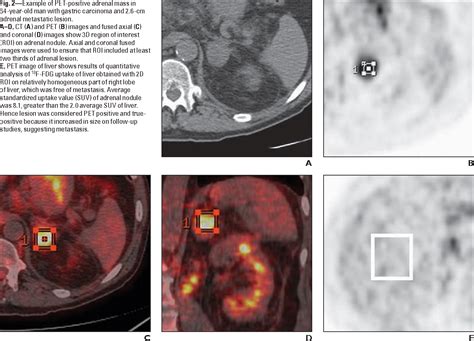 Figure 2 From Utility Of PET CT In Differentiating Benign From