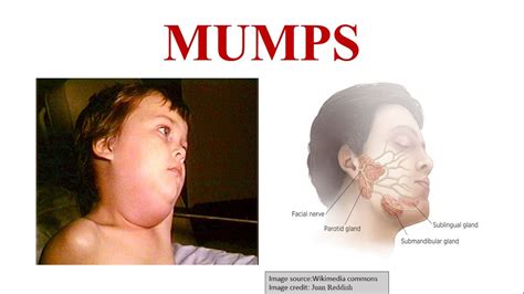 Mumps History Cause Symptom Diagnosis And Prevention Of Mumps Youtube