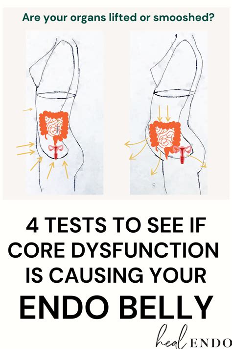 What Is Endo Belly Series Part 1 Core Dysfunction Artofit