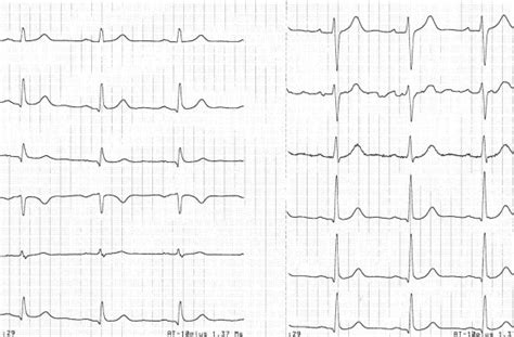 Differentiation Between Arrhythmogenic Cardiomyopathy And Early