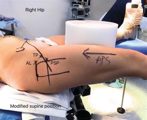 Hip Arthroscopy Made Simple Easy And Elegant A Novel Variant Of The