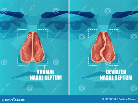 Normal Nasal Cavity Versus Rhinitis Anatomy Illustration